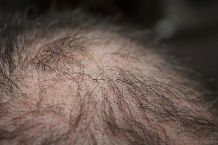 Get rid of hair fall