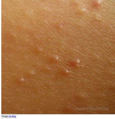 White-Bumps-on-skin