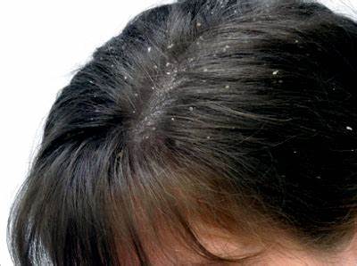 Winter dandruff