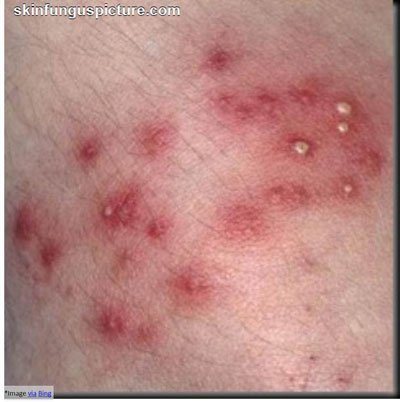skin-Infections