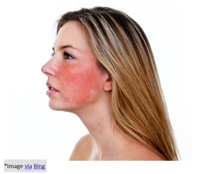 Home Remedies to Reduce Redness on Face