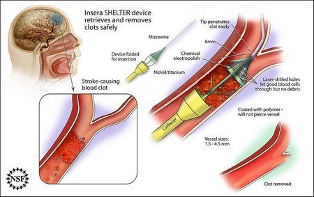 blood clots