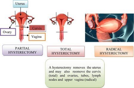 Cervical cancer- causes, symptoms and treatment