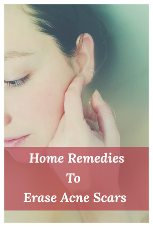 home remedies to erase acne scars