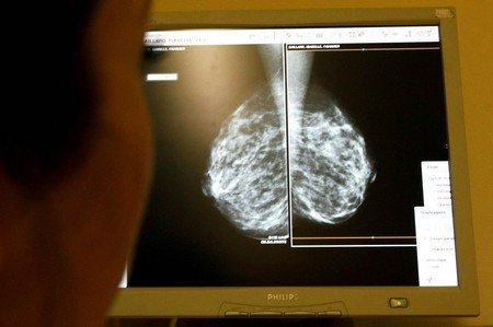 Prevent Breast Cancer Risk Effectively