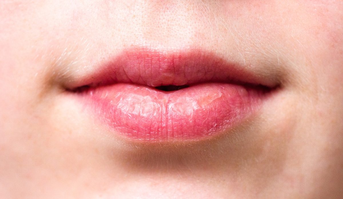Heal Dry Lips Naturally With 10 Easy Home Remedies