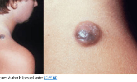 The Best Mole Removal Natural Solution Ever You Can Get