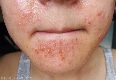 Skin allergy