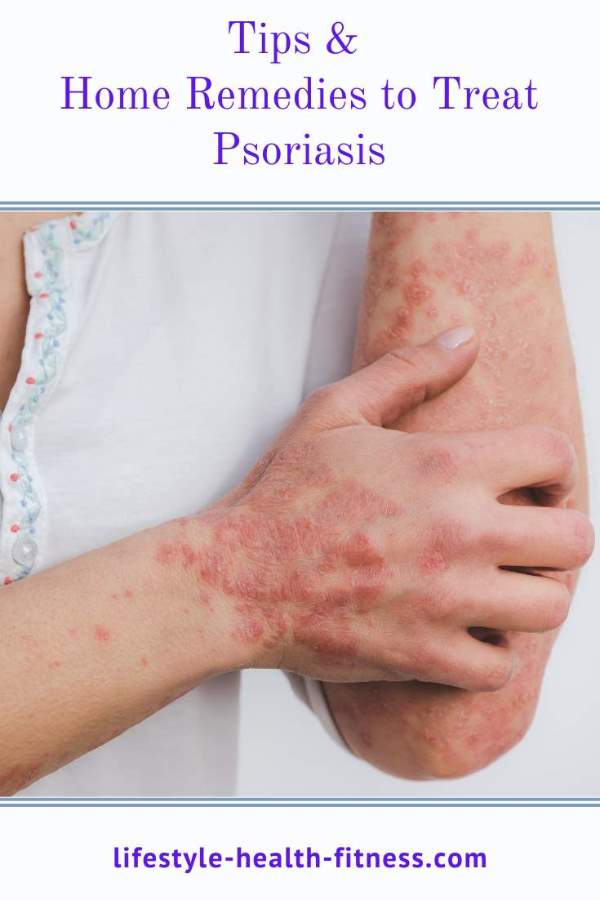 Home Remedies for Psoriasis Problem