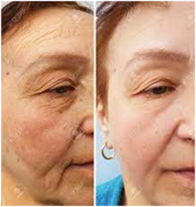 Skin cell therapy- before & after