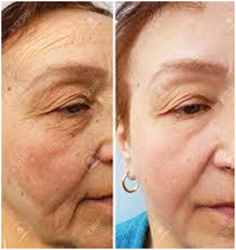 Skin cell therapy- before & after