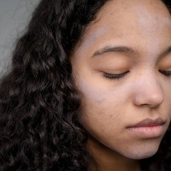 hyperpigmentation on face due to acne