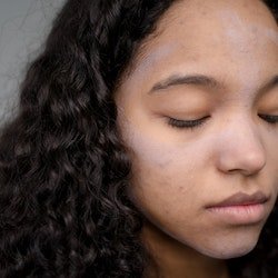 hyperpigmentation on face due to ace